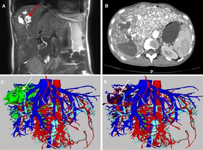 Right hemihepatectomy combined with ligation of the common hepatic artery and gastroduodenal artery for the treatment of intrahepatic HHT: A case report